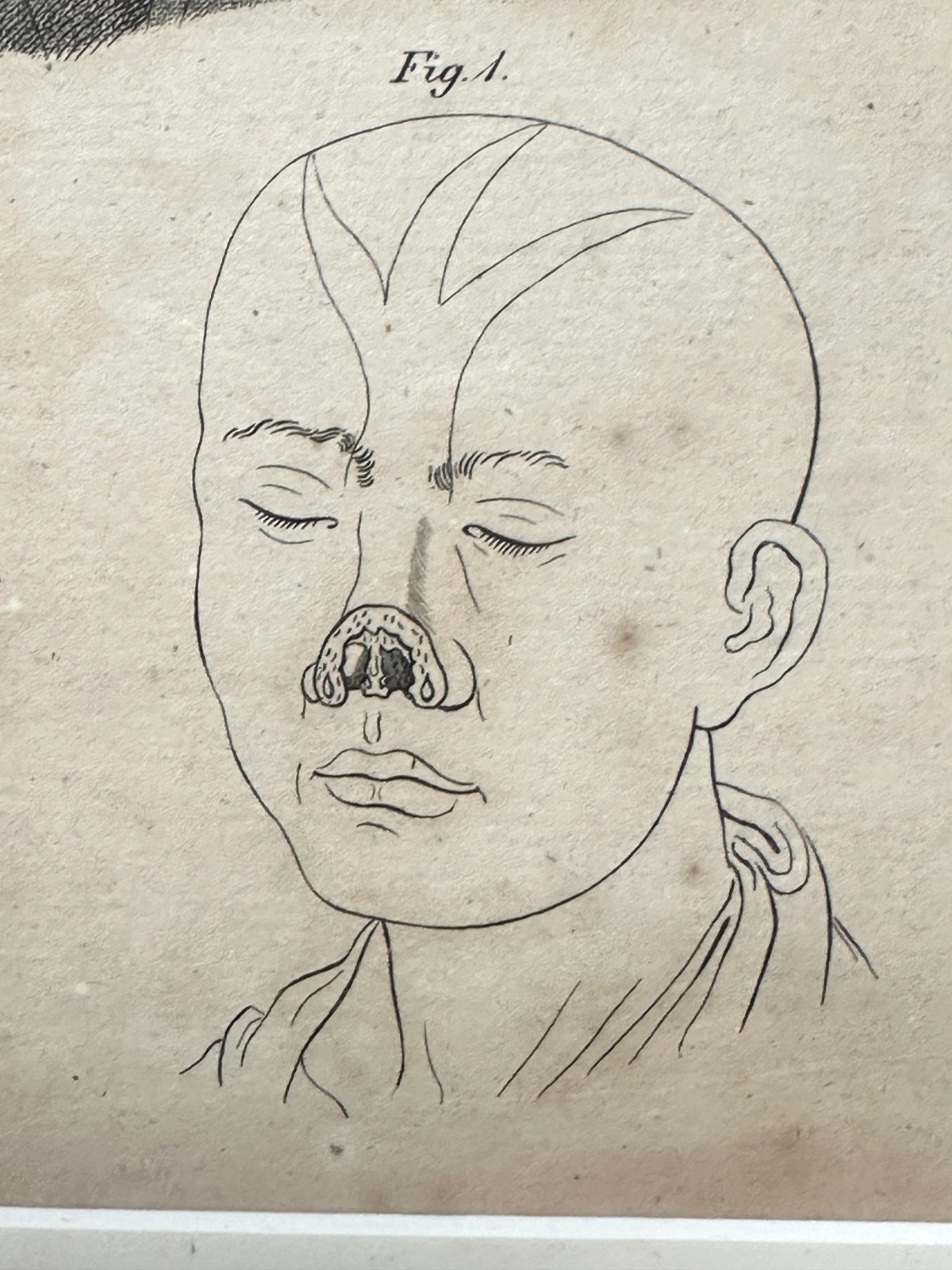 Antiker Kupferstich um 1830 – Rhinoplastik nach Delpech – Nasen-OP Darstellung8
