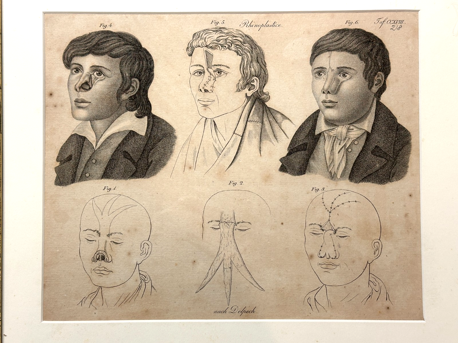 Antiker Kupferstich um 1830 – Rhinoplastik nach Delpech – Nasen-OP Darstellung1