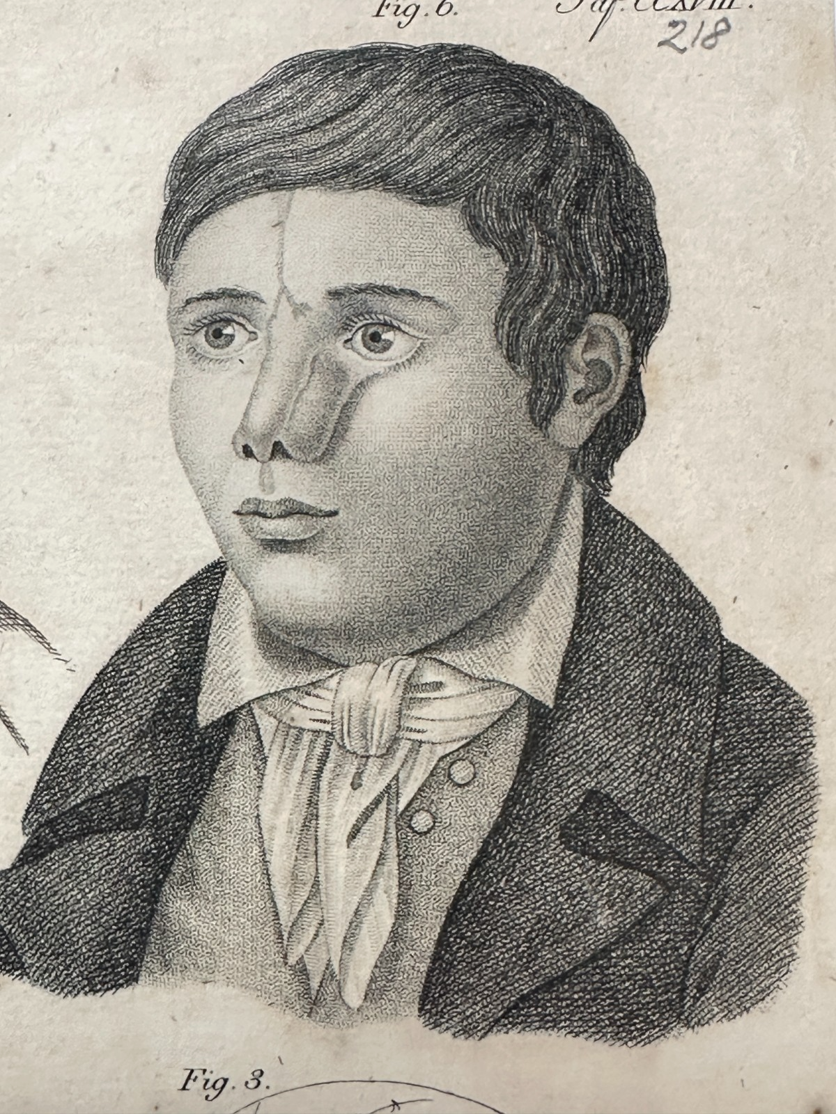 Antiker Kupferstich um 1830 – Rhinoplastik nach Delpech – Nasen-OP Darstellung7