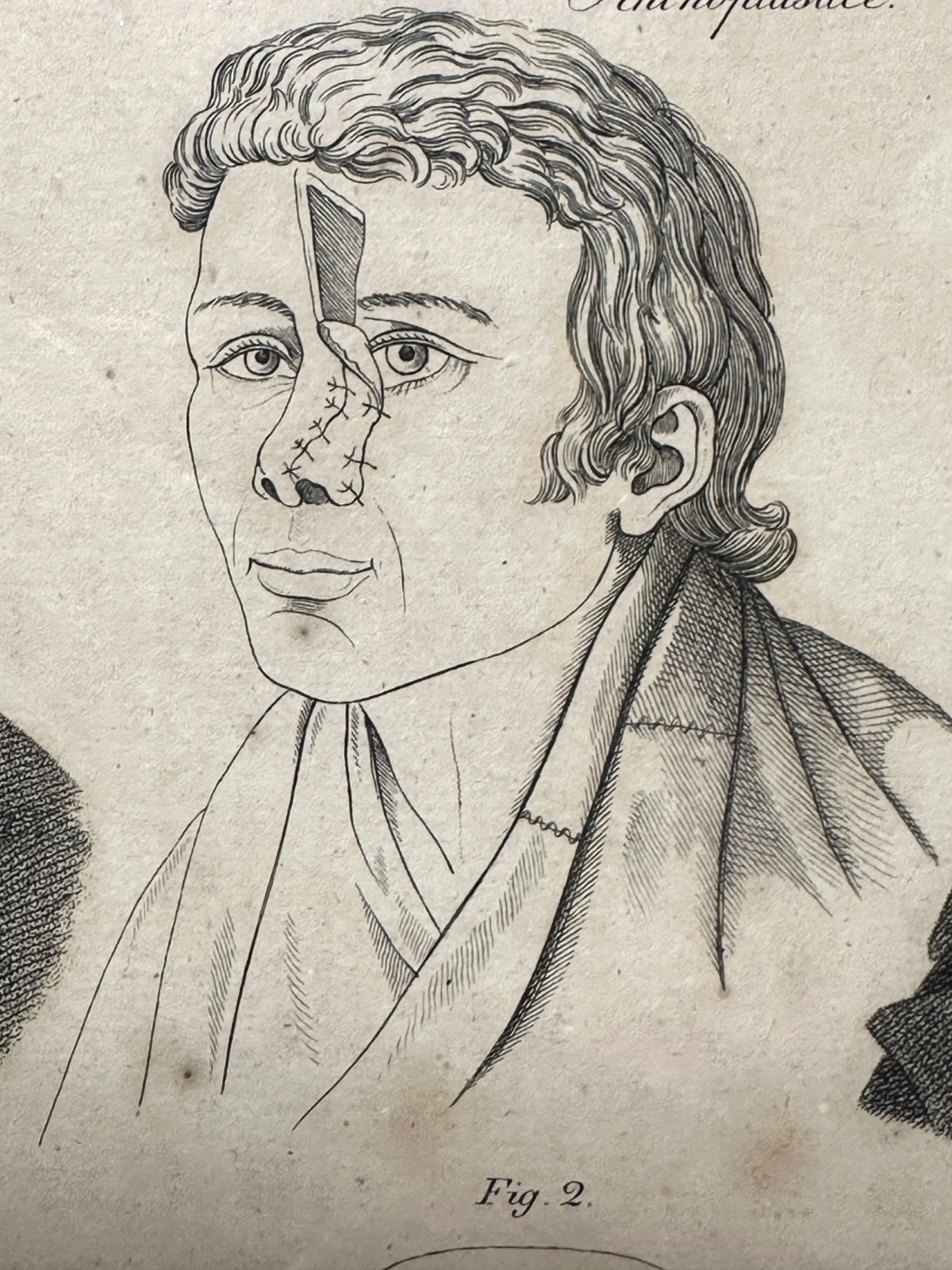 Antiker Kupferstich um 1830 – Rhinoplastik nach Delpech – Nasen-OP Darstellung6
