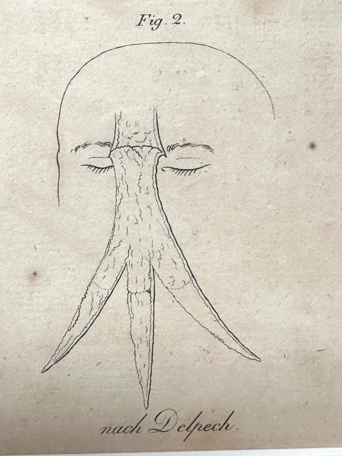 Antiker Kupferstich um 1830 – Rhinoplastik nach Delpech – Nasen-OP Darstellung9
