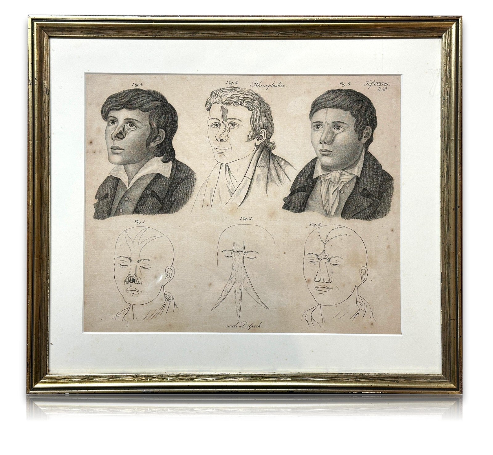Antiker Kupferstich um 1830 – Rhinoplastik nach Delpech – Nasen-OP Darstellung0