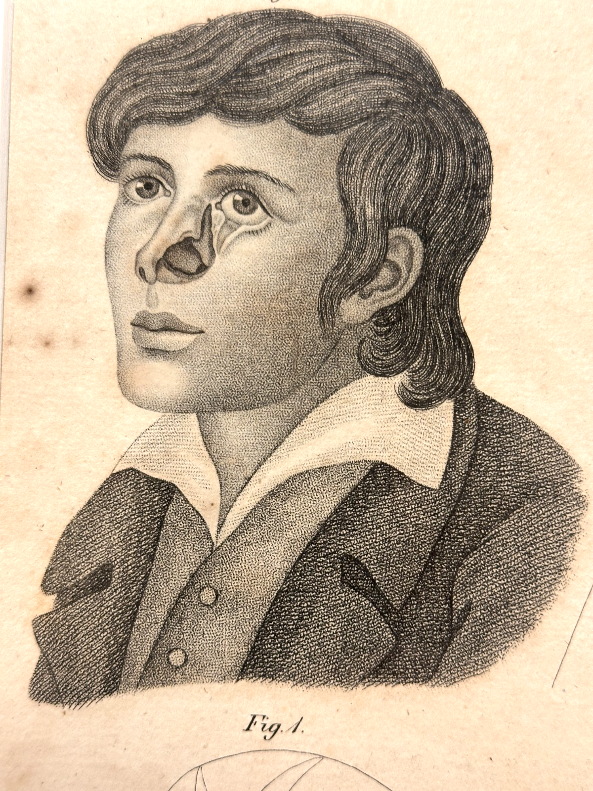 Antiker Kupferstich um 1830 – Rhinoplastik nach Delpech – Nasen-OP Darstellung2
