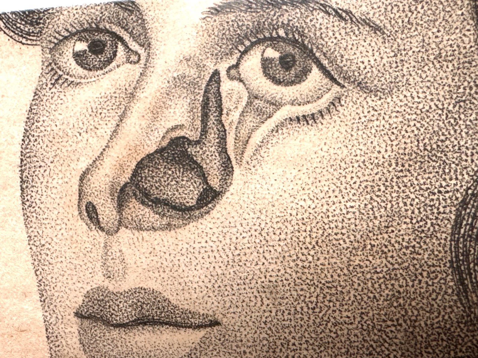 Antiker Kupferstich um 1830 – Rhinoplastik nach Delpech – Nasen-OP Darstellung3