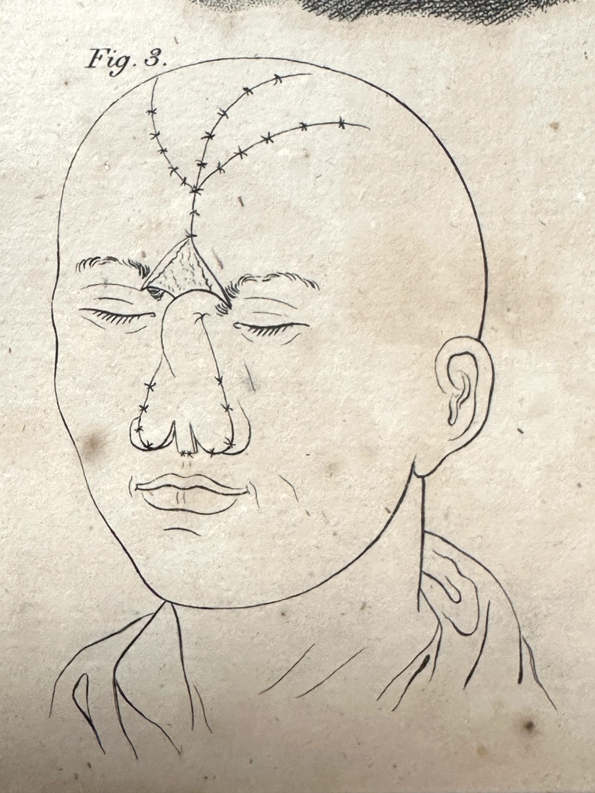 Antiker Kupferstich um 1830 – Rhinoplastik nach Delpech – Nasen-OP Darstellung10